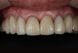 セラミック治療後