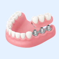 コーヌスクローネデンチャー