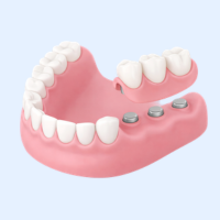 マグネットデンチャー