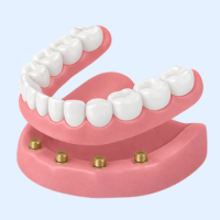 ロケーターアタッチメント