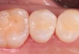 セラミック症例02後