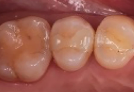 セラミック症例02前