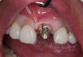 インプラント症例01前