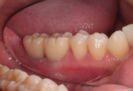 インプラント治療後