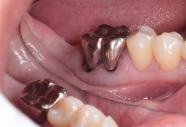 インプラント治療前