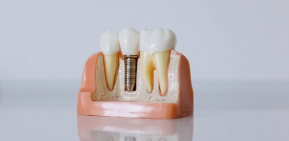 インプラントの模型